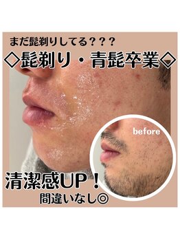 アート 熊本並木坂店(ART)/フラッシュワックス脱毛/ヒゲ