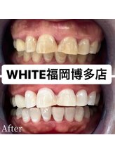 ホワイト 福岡博多店(WHITE)/ホワイトニング通い放題ビフォー