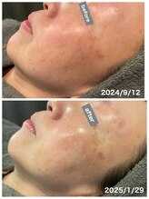 レミュー(remiu)/小顔＆しみくすみケア