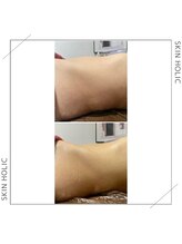 スキンホリック 恵比寿駅前店(SKIN HOLIC)/3ヶ月集中☆痩身★