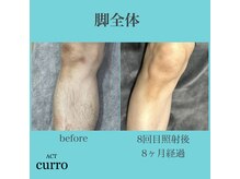 アクト クロ(ACT curro)/【脚全体】脱毛施術例