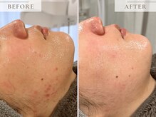 レヴィア(Revia)/ニキビケアにもハーブピーリング