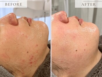 レヴィア(Revia)/ニキビケアにもハーブピーリング