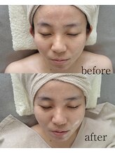 メルーラ(Mellura)/フェイシャルのbefore/after