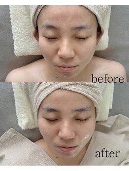 メルーラ(Mellura)/フェイシャルのbefore/after