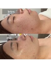 ア ルフレ(A.reflet)/before、after