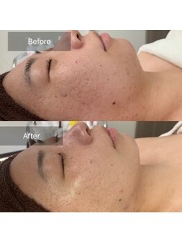 ア ルフレ(A.reflet)/before、after