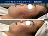 〈徹底ニキビケア〉 フォトRF肌質改善+ビタミン導入セット　¥5,980