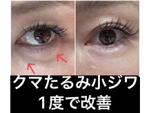 スペチアーレ 夙川/【アイリフト】で目元改善