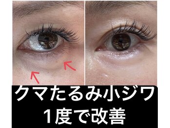 スペチアーレ 夙川/【アイリフト】で目元改善
