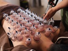 繁内鍼灸治療院/カッピング