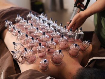 繁内鍼灸治療院/カッピング