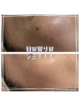 ベビースキン(baby skin)/シミ改善