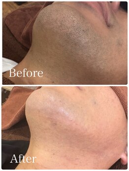 シーズ ザ デイ 熊本店(Seize the day)/4回の施術でこの変化!