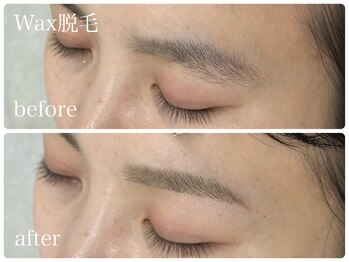 フルミー(fulme.)/WAX脱毛before&after