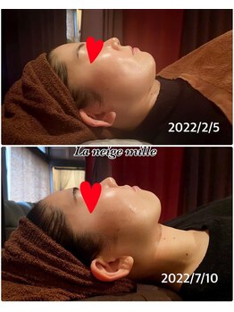 ラネージュミル(La neige mille)/小顔フェイシャル