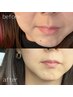 【光フェイシャル】★1度でわかる引き上がり〈パック・ヘッドマッサージ付〉