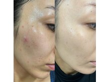 レミュー(remiu)/テラボーラー＆美白パック