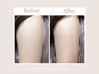 トータルビューティー ゆみえエステ(Total Beauty)/痩身/ハイパーナイフ下半身集中