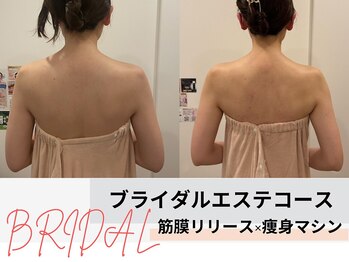 ミルズ 天神店(MillS)/ブライダルエステコース