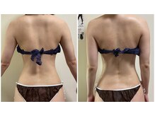 ニコワ(Nicowa)/Nicowaの痩身★BeforeAfter