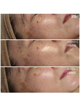 ベビースキン(baby skin)/シミ改善