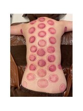 ラブームココ(LaBoom CoCo)/カッピングで睡眠の質改善★