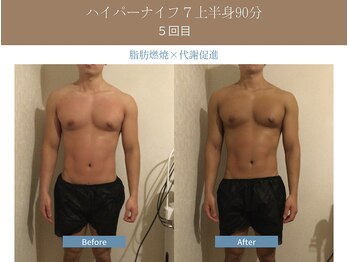 漢方アロマヒーリングサロン 浦和店(漢方AROMAヒーリングサロン)/ハイパーナイフ7上半身◆5回目