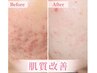 【学割U24★肌質改善クーポン】美顔鍼×美容液導入 ニキビ改善◎