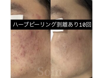 ソアン(Soin)/肌質改善