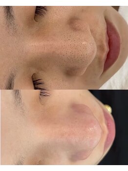 Ai.meri アメリサロンの写真/頑固な黒ずみ・角栓を徹底大掃除!選べる毛穴洗浄フェイシャルで、毛穴レスなうるツヤ陶器肌へ導きます★