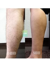 サロンドエーゼット(Salon de AZ)/Men's脱毛もこの結果！