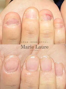マリーロール 天王寺店(Marie Laure)/深爪矯正/自爪育成/ネイルケア
