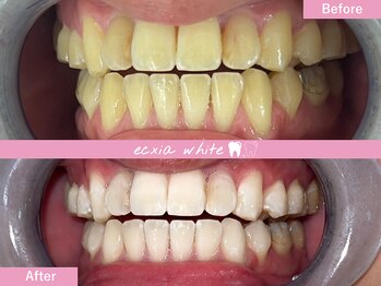 エクシアホワイトニング 札幌中島公園店/ホワイトニングビフォーアフター
