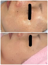縁(en)/しみケア５回のお客様☆