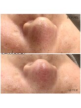 エミルカ(EMILUCA)/毛穴洗浄★ハイドロスプラッシュ