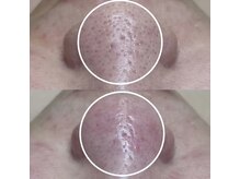 ビオルブ(VIOLVE)/毛穴エクストラクション