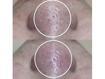 ビオルブ(VIOLVE)/毛穴エクストラクション