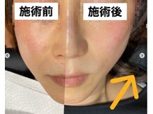 アウンビューティケア AUN薬局(AUN Beauty Care)/小顔ケア♪