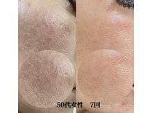 ブレア(Blair)/マイクロニードル×ピンクグロウ