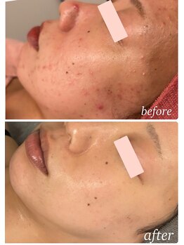 プレジール(Plaisir)/人気No. 1サーマ＋ララピ-ル+LDM