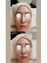 ノイ(Noi)/【小顔×チタニウムリフト】