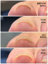 地爪ケアクリニックサロン 代々木店/巻き爪ケアジェル（2回施術後）