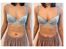 リソラ(risora)/40代｜バストケア5回 