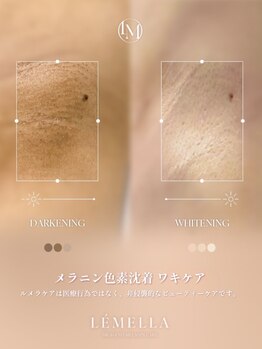 フリュール(FLEUR)の写真/黒ずみ・色素沈着解消！メラニンケアでトーンアップ♪肘/膝の黒ずみにも◎一度で効果実感♪