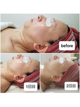 ふらっとエステ/たるみ改善へ