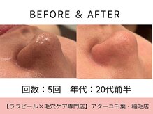 ア クーユ 稲毛店/毛穴洗浄/毛穴の黒ずみ/ざらつき