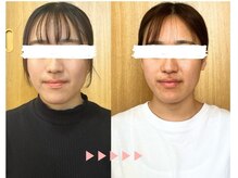 サリー(Sally)/小顔　Bfore After