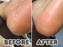 ポドロ ウィズ ニコルル 大阪天満店(PoDoLo with Nicolulu)/【ガサガサかかと】角質ケア大阪