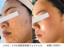 アンシャンテ 神戸元町店(Enchante)/肌質改善ピーリングフェイシャル